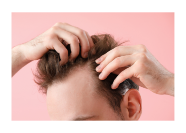 Male Hair Loss: Causes, Prevention, and Treatment